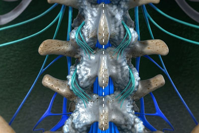 Understanding age related spine problems